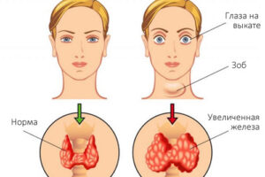 Лечение базедовой болезни в Израиле