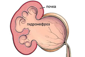 Лечение гидронефроза почки в Израиле