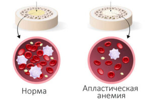 Лечение апластической анемии в Израиле