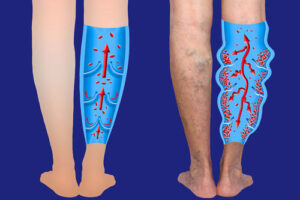 Лечение лимфостаза в Израиле