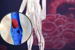 Лечение тромбоза, эмболии в Израиле