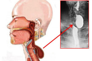 Лечение дивертикула пищевода в Израиле