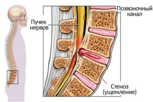 Лечение стеноза позвоночного канала в Израиле