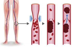 Лечение тромбоза глубоких вен в Израиле