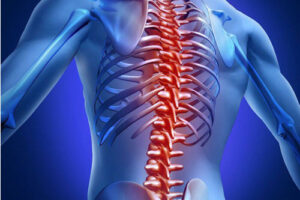 Лечение доброкачественных опухолей позвоночника в Израиле