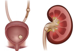 Лечение мочекаменной болезни в Израиле