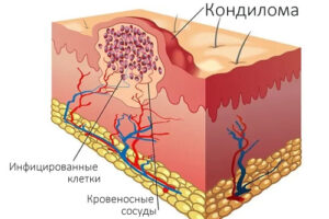 Лечение кондилом в Израиле