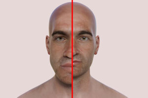 Лечение акромегалии в Израиле