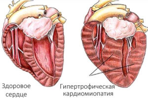 Лечение гипертрофической кардиомиопатии в Израиле