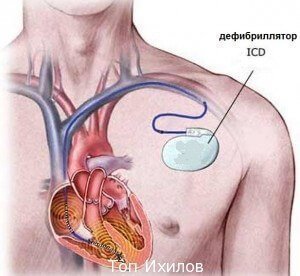 Имплантация ICD-аппаратов