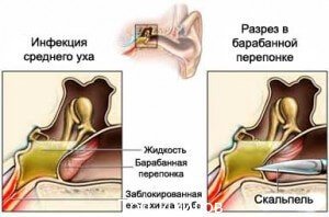 Разрыв барабанной перепонки