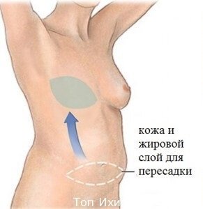 Реконструкция груди после мастэктомии