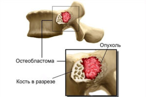 Лечение остеобластомы позвоночника в Израиле