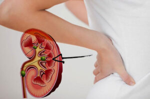 Лечение заболеваний канальцевого аппарата почек в Израиле