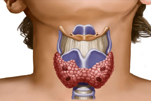 Тиреоидит - причины, симптомы, диагностика и лечения воспаления щитовидной железы