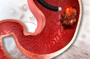 Лечение лимфомы желудка в Израиле