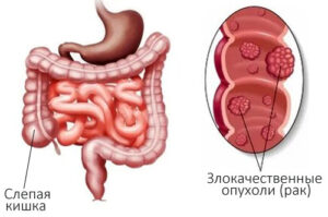Лечение рака слепой кишки в Израиле