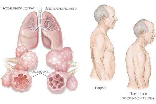 саркоидоз. - Заболевания легких и дыхательных путей - Справочник MSD Версия для потребителей