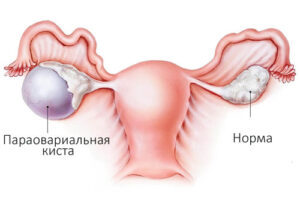Лечение параовариальных кист яичников в Израиле