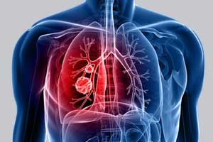 Фиброз лёгких — что это, опасен или нет, симптомы, лечение