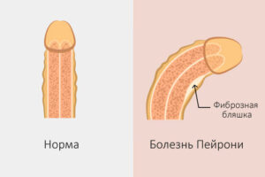 Лечение болезни Пейрони в Израиле