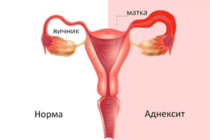 Лечение аднексита в Израил