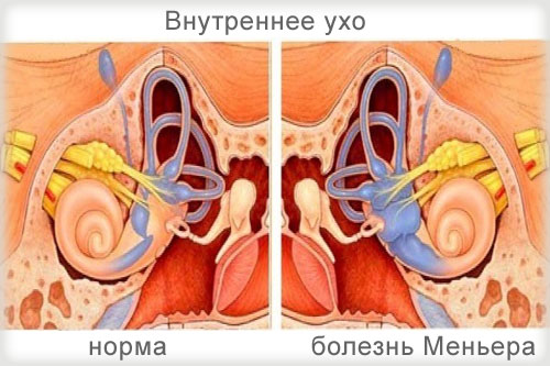 Шум в ушах - причины, диагностика, лечение