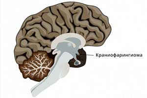 краниофарингиома головного мозга