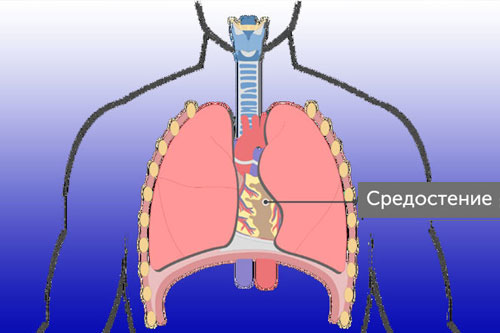 Лечение лимфомы средостения в Израиле | Ихилов