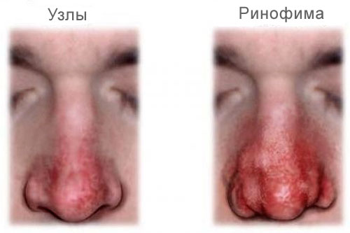 Заболевания наружного носа