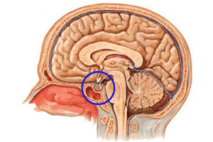 Лечение герминомы головного мозга в Израиле