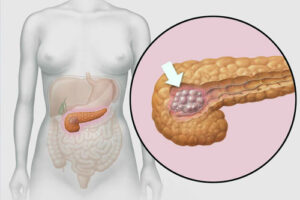 Лечение рака головки поджелудочной железы в Израиле