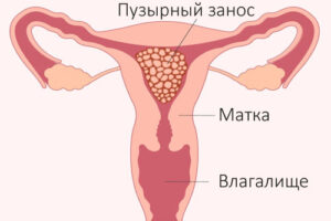 Лечение пузырного заноса в Израиле