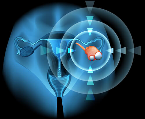 Папиллярная цистаденома яичника: причины возникновения, симптомы, методы лечения