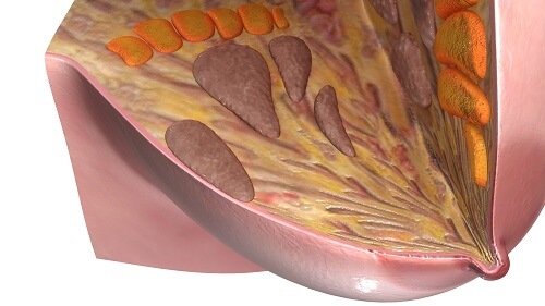 Лечение туберкулеза молочных желез в Израиле | Ихилов