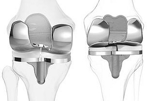 Эндопротезирование суставов: ТОП-5 часто задаваемых вопросов ортопеду