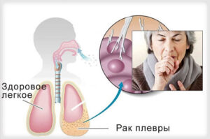 Лечение рака плевры в Израиле