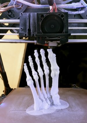 3D-печать в ортопедии
