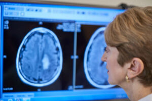 Лечение глиоматоза в Израиле