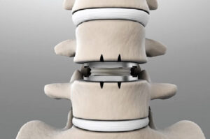 Имплантация искусственного диска